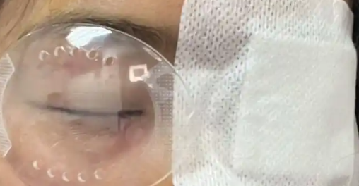 飞秒激光和晶体植入对比，哪种手术方式更安全